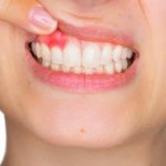 Ожог десны: виды ожогов, причины, симптомы и лечение, восстановительный период и советы стоматолога