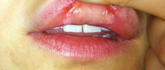 Tongue burn from ammonia what to do
