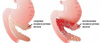 Pancreatitis