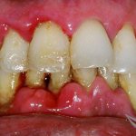 Periodontitis
