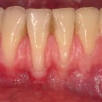 Periodontal disease treatment with hydrogen peroxide and soda