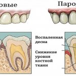 Пародонтоз зуба больного