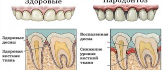 Periodontal disease of the patient's tooth