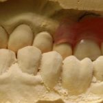 патология зубов - перекрестный прикус
