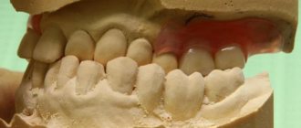 dental pathology - crossbite