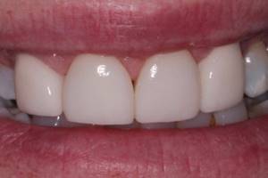 передние зубы