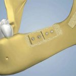 bone block transplantation