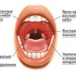 Первые проявления гингивостоматита