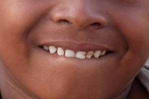 Пигментация зубов у детей
