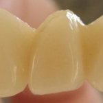 пластмассовые коронки на передние зубы отзывы пациентов стоматологий