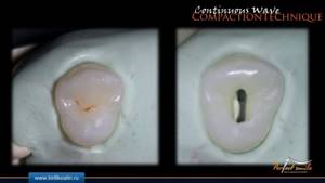 пломбировка каналов зуба вертикальной конденсацией гуттаперчи