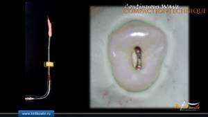 пломбировка каналов зуба вертикальной конденсацией гуттаперчи