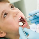 Filling material Estelite for restoration of anterior teeth