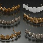 Плюсы и минусы металлических коронок с напылением