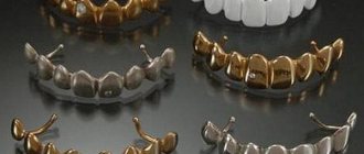 Плюсы и минусы металлических коронок с напылением