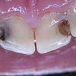 Why do my upper front teeth hurt and ache?
