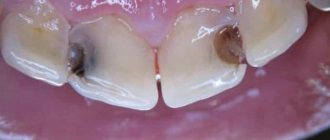 Почему болят и ноют передние верхние зубы