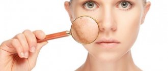 Why do red spots appear on the face?
