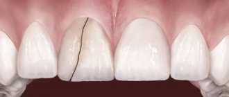 Why is a tooth cracked and what should the patient do immediately?