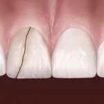 Why is a tooth cracked and what should the patient do immediately?