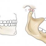 Почему возникает тризм челюсти