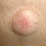 subcutaneous ball on the mammary gland