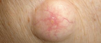 subcutaneous ball on the mammary gland