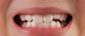 tooth mobility