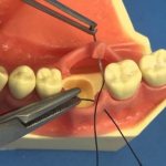 Показания к ушиванию лунки зуба