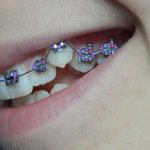 Показания к установке брекетов на клыки