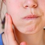 полоскание рта содовым раствором