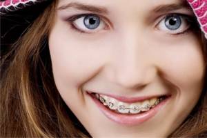 Портят ли брекеты эмаль зубов?