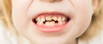 Child's teeth deteriorate
