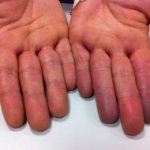 Посинение пальцев