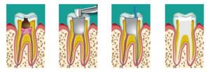 После чистки каналов болит зуб при нажатии что делать