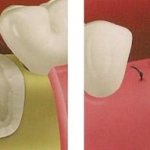 После сложного удаления зуба