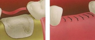 After a complex tooth extraction