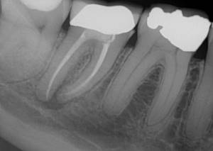 После удаления зуба задет тройничный нерв лечение
