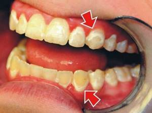 Постепенное разрушение твердых тканей зуба