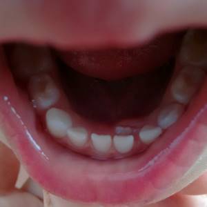 Постоянный зуб растет за молочным — что делать?