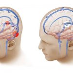 Increased intracranial pressure