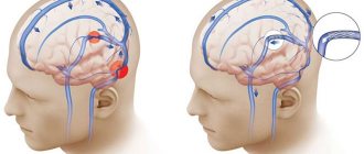 Increased intracranial pressure