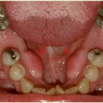 The appearance of exostosis after tooth extraction and surgery to eliminate it