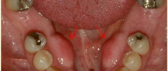 Появление экзостоза после удаления зуба и операция по его устранению