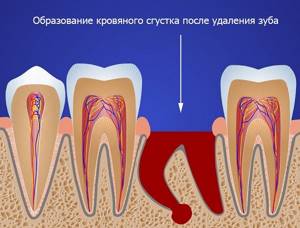 появление кровяного сгустка после удаления зуба