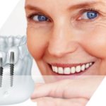 Advantages and disadvantages of two-stage dental implantation