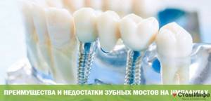 Преимущества и недостатки зубных мостов на имплантах