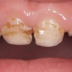 With poor oral hygiene, tooth enamel can be destroyed very quickly in some cases, especially in baby teeth.