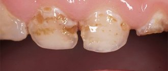 При плохой гигиене полости рта зубная эмаль может разрушаться в ряде случаев очень быстро, особенно у молочных зубов.