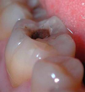 При запущенной форме кариозного процесса может потребоваться депульпация (удаление зубного нерва).